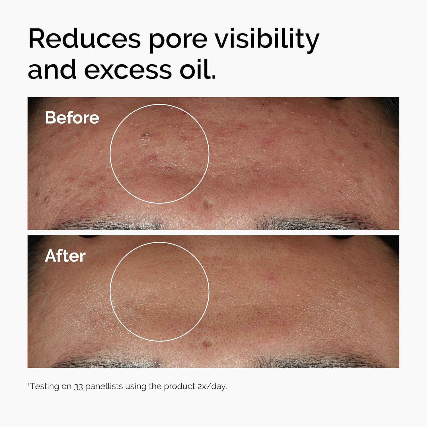 The Ordinary Niacinamide 10% + Zinc 1%, Brightening & Smoothing Serum for Blemish-Prone Skin, 30ml - Image 3